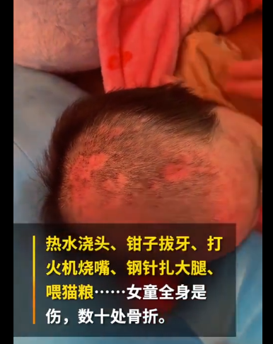 156万！爱心如潮涌向辽宁6岁被虐女童，父亲：善